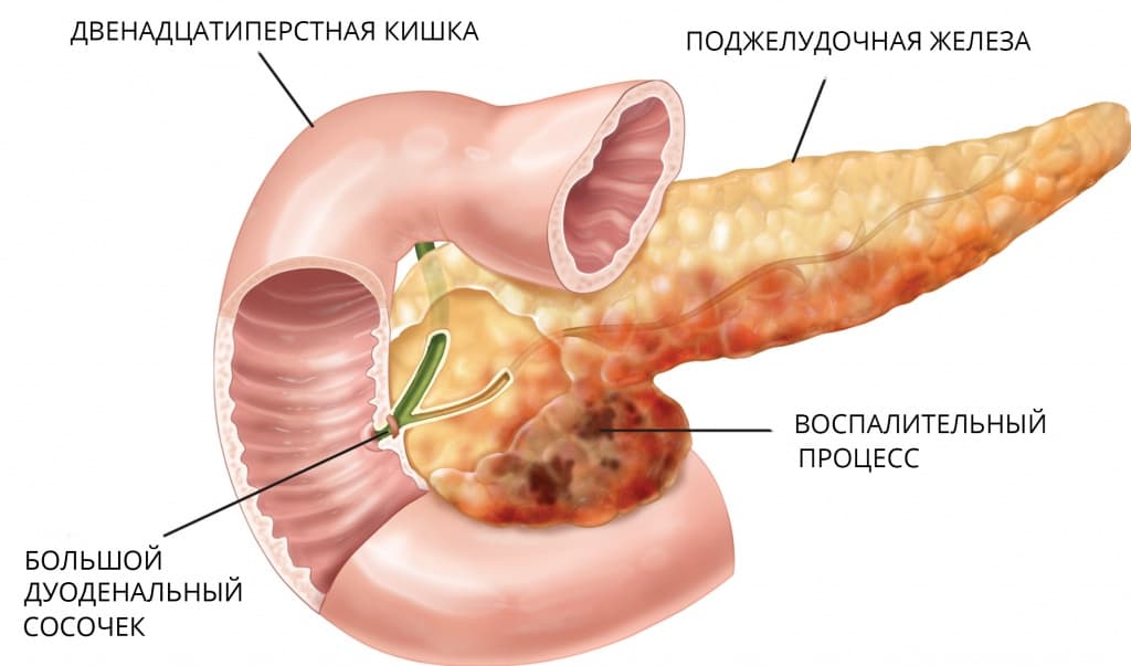 Омс по острому панкреатиту thumbnail