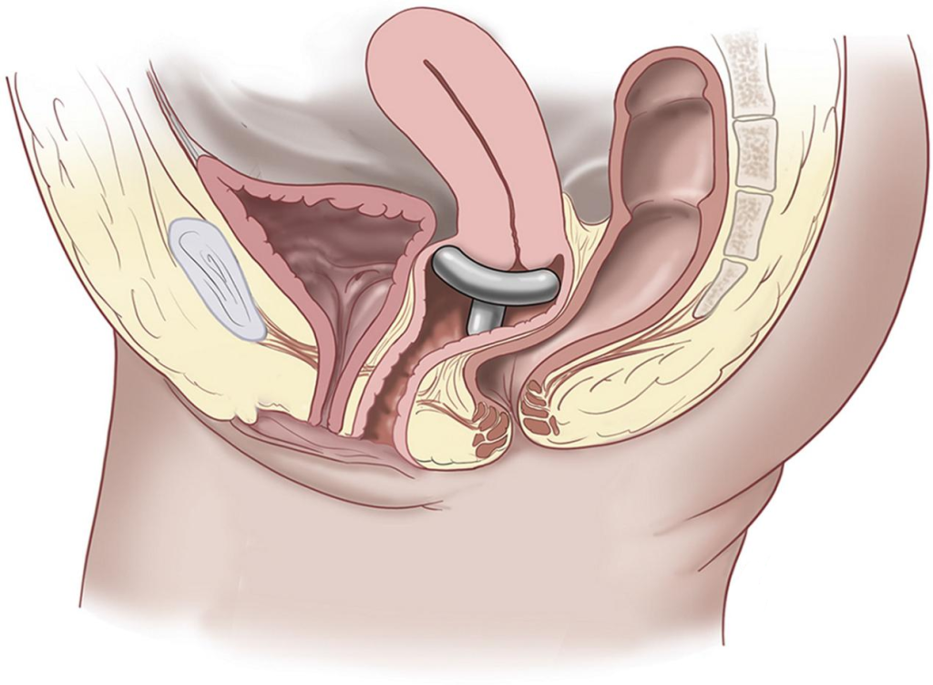 Пессарий во влагалище.png