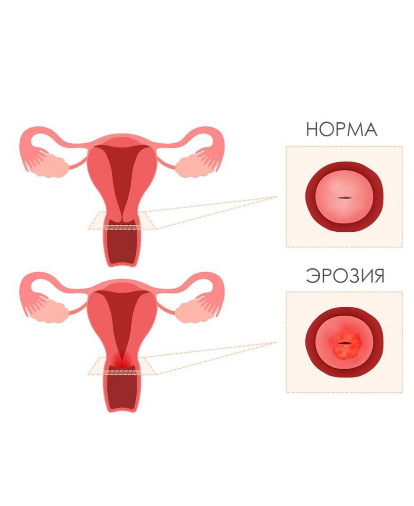 эрозия шейки матки.jpg