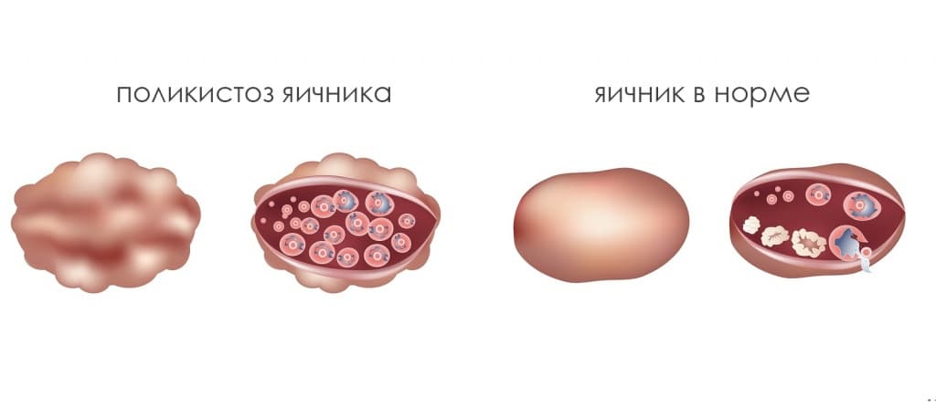 Синдром поликистозных яичников или мультифолликулярные яичники