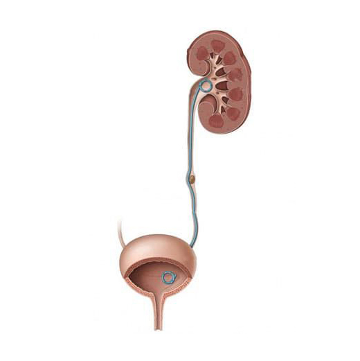 стент мочеточника.jpg