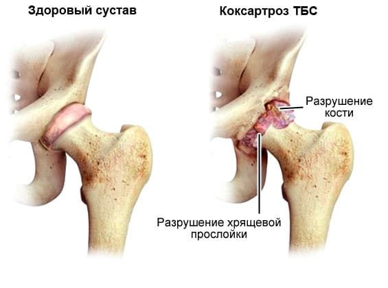Лечение тазобедренного сустава в санкт петербурге thumbnail
