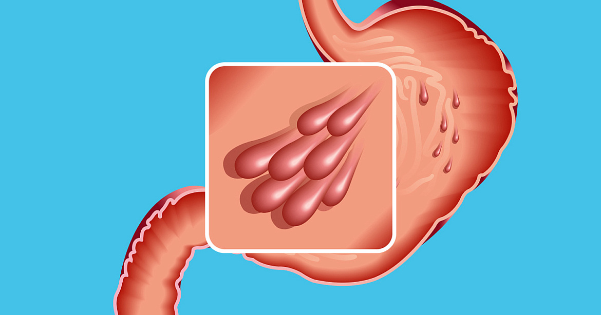 Полипы желудка