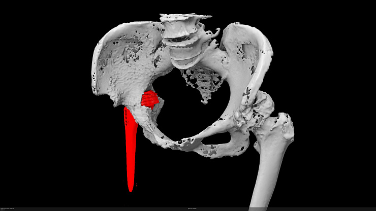 Что делать, когда стандартный имплант не подходит?