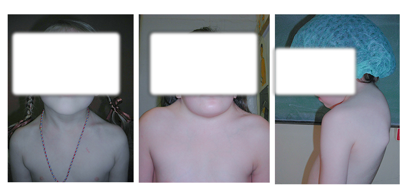 Костная кривошея, короткая шея (синдром Клиппеля-Фейля) и кифоз