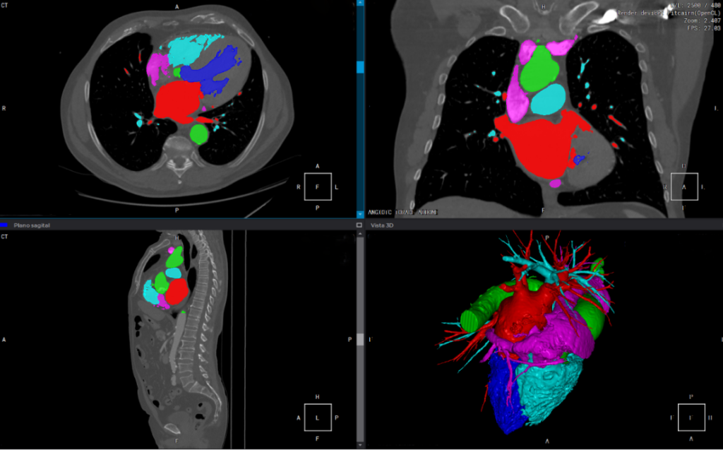 Рис. 1. На основании компьютерной томографии осуществляется сегментирование тканей с последующей 3D-визуализацией и при необходимости изготавливаются модели для различных операций.