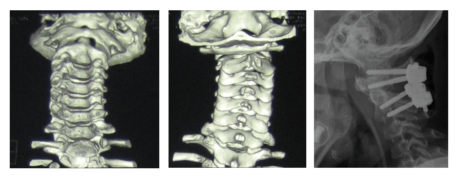 Рис. 1 3Д КТ- реконструкция соотношений в С1 - С2. С1 смещен влево и вперед и блокирован в этой позиции. Произведено вправление и фиксация атланта и аксиса с помощью 2-х пар винтов, соединенных стержнями.