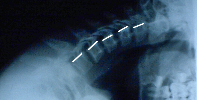 Рентгенограмма шейного отдела позвоночника с наклоном вперед у ребенка 15 лет, небольшие «ступеньки» между телами позвонков – это норма.
