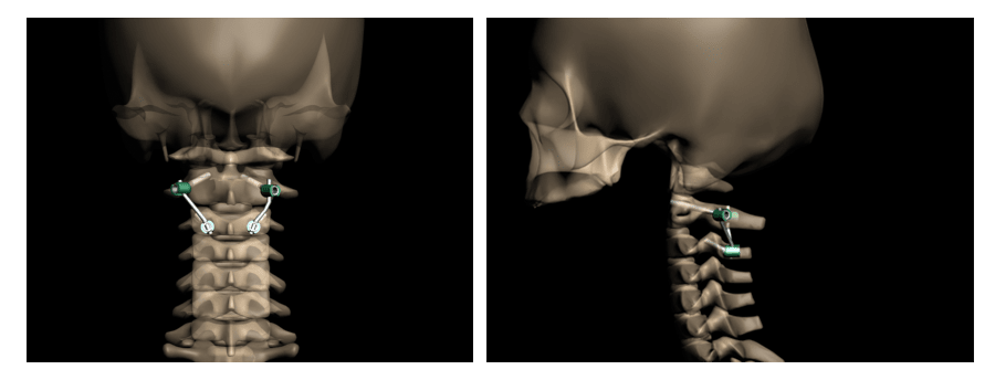 Рис.3 Схема репозиции и фиксации позвонков при переломе палача