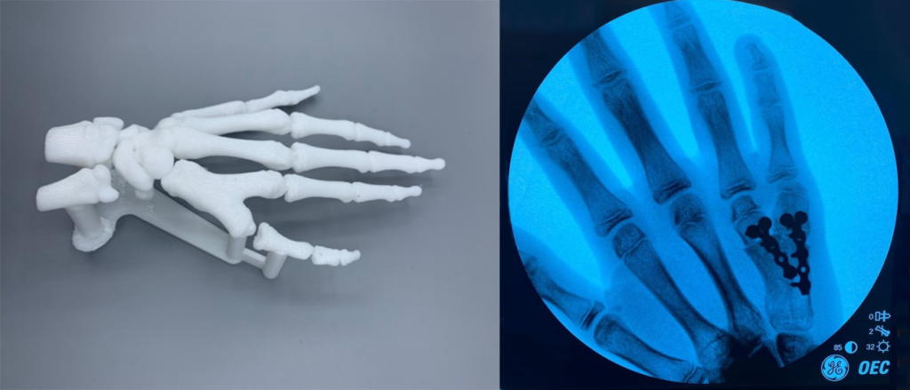 Рис.4 Произведена реконструкция на модели, которая помогла лучше определить тактику лечения, соразмерность при выборе инструмента, а также правильно подобрать расходные материалы.